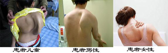 貴陽強(qiáng)直醫(yī)院不同性別、年齡都有可能患有強(qiáng)直性脊柱炎.jpg